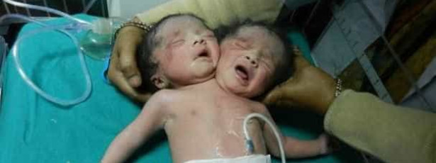 Bebê nasce com duas cabeças na Índia