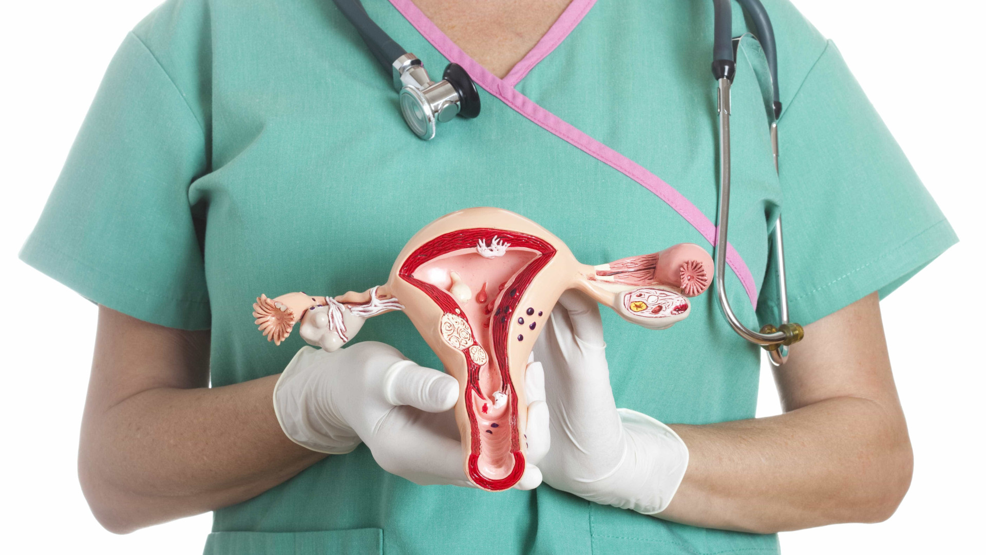 Cirurgia de mioma que preserva o útero aumenta chance de engravidar