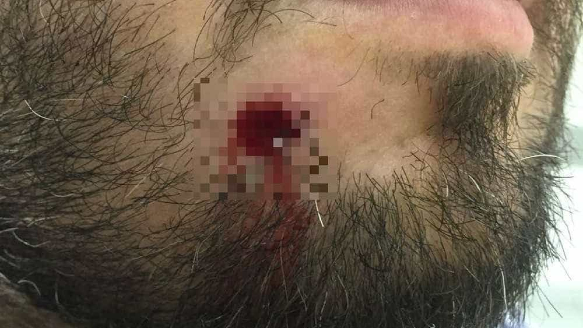 Turista é baleado no rosto e retira a bala do próprio dente