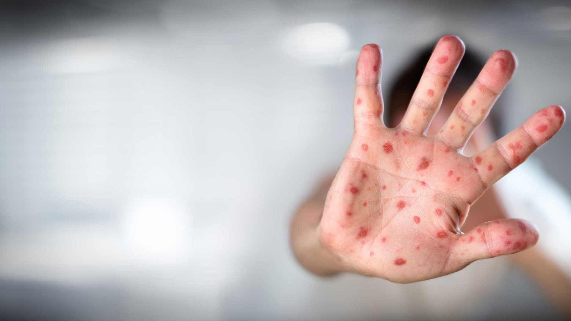 Ministro da Saúde diz que não há risco de sarampo se espalhar pelo país