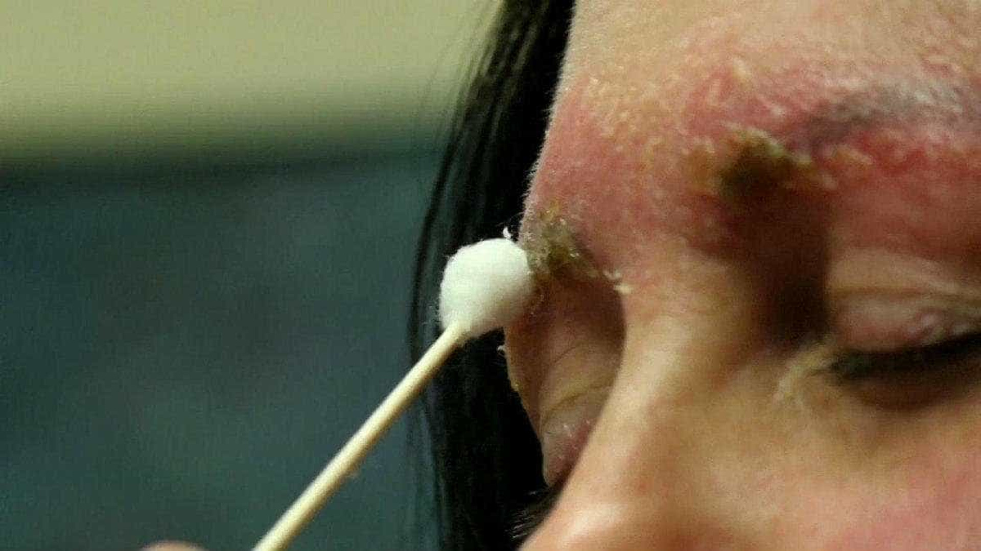 Microblading: mulher quase morre apÃ³s infecÃ§Ã£o na sobrancelha