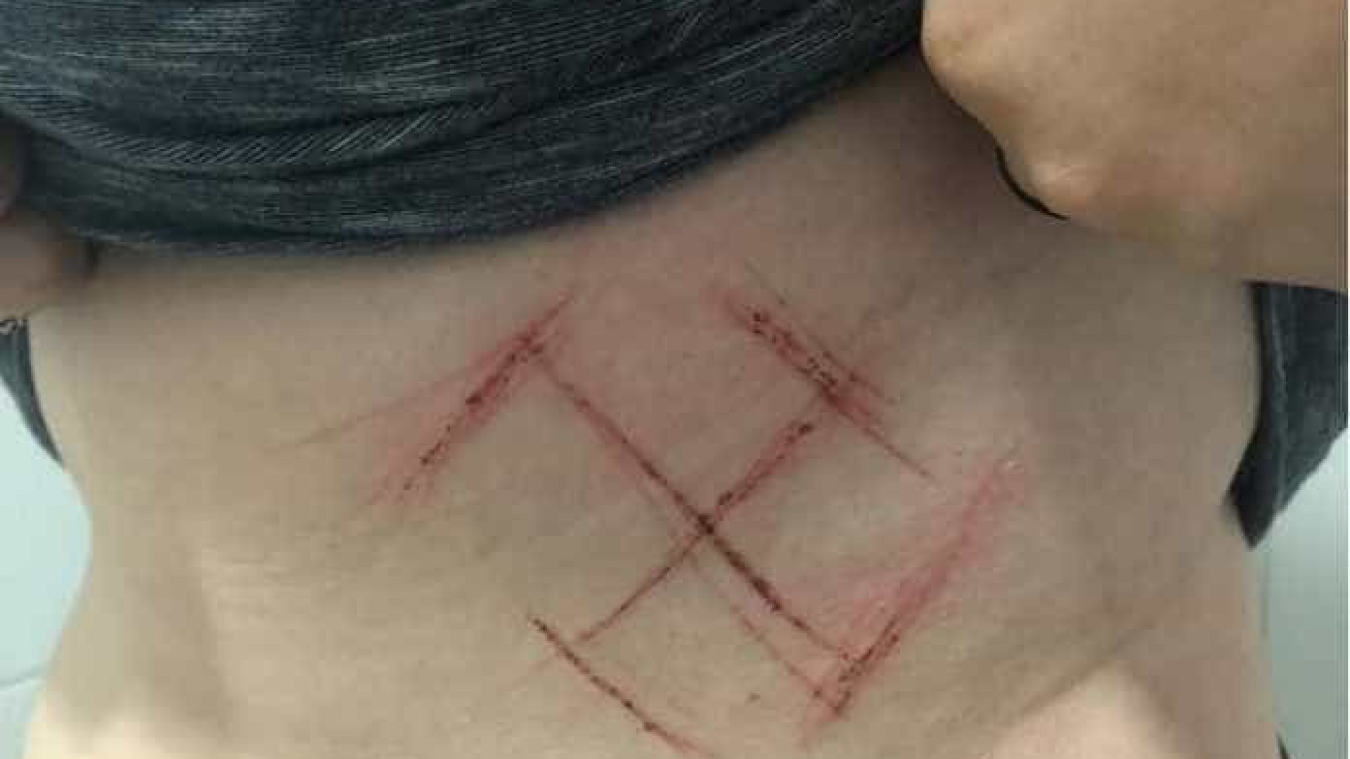 Jovem tem suástica marcada na pele por usar adesivo de #EleNão